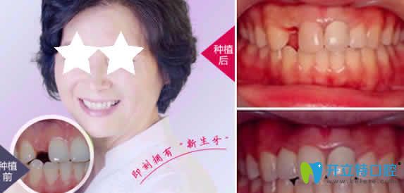 上海恒佳齿科刘佳即刻种植牙案例
