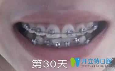 我在上海恒美口腔做牙齿矫正第30天照片