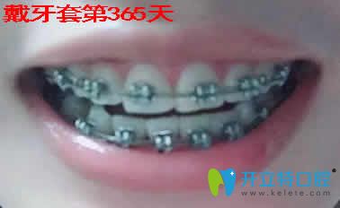 我在上海恒美齿科做牙齿矫正1年的效果