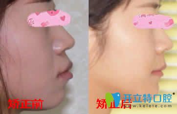 上海恒佳口腔隐形牙齿矫正前后脸型对比图