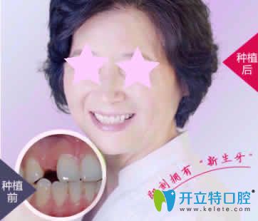 上海恒佳齿科即刻种植牙案例图
