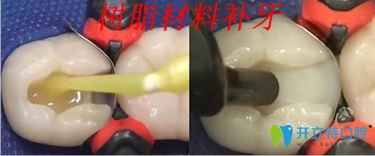 树脂材料补牙过程图
