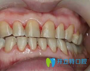 分享一波我在苏州锦城口腔做全瓷牙齿贴面的前后照片