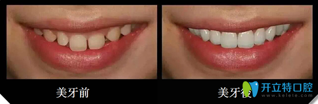 深圳三康口腔3d牙贴面修复牙齿案例