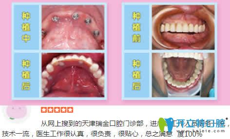天津瑞金口腔种植牙<span style= 天津瑞金口腔种植牙<span style=