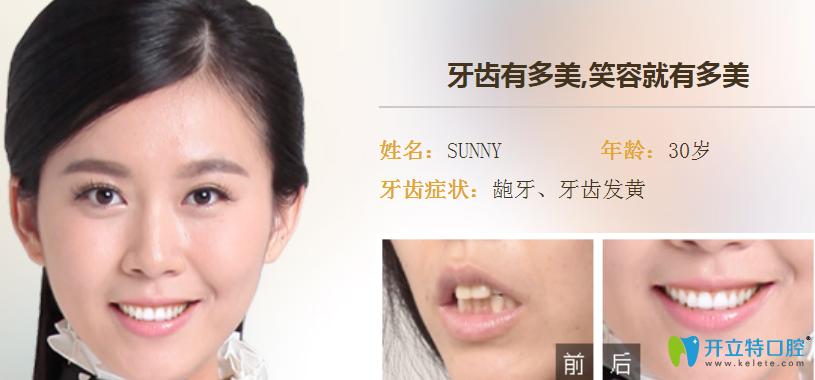 属于广州德伦口腔龅牙隐形矫正案例效果对比图