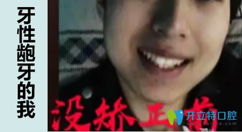 上海维尔口腔谁说拔牙正畸脸型毁了?看我在上海维尔拔四颗牙的脸型变化