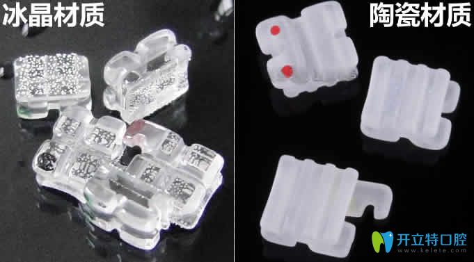冰晶牙套与陶瓷牙套材质区别图 冰晶牙套与陶瓷牙套材质区别图