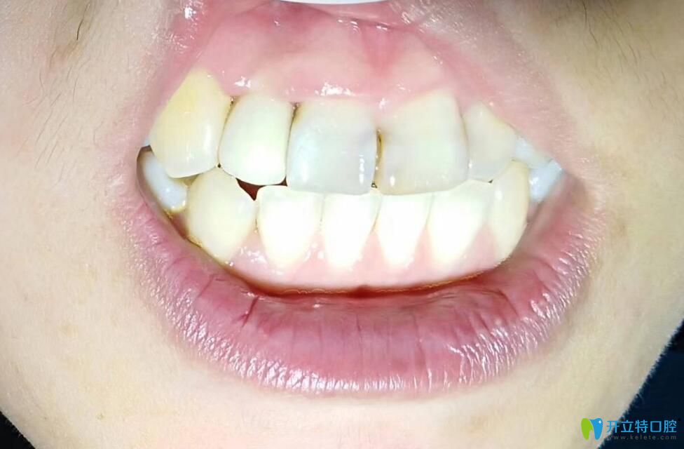 三康口腔牙齿种植即刻病例