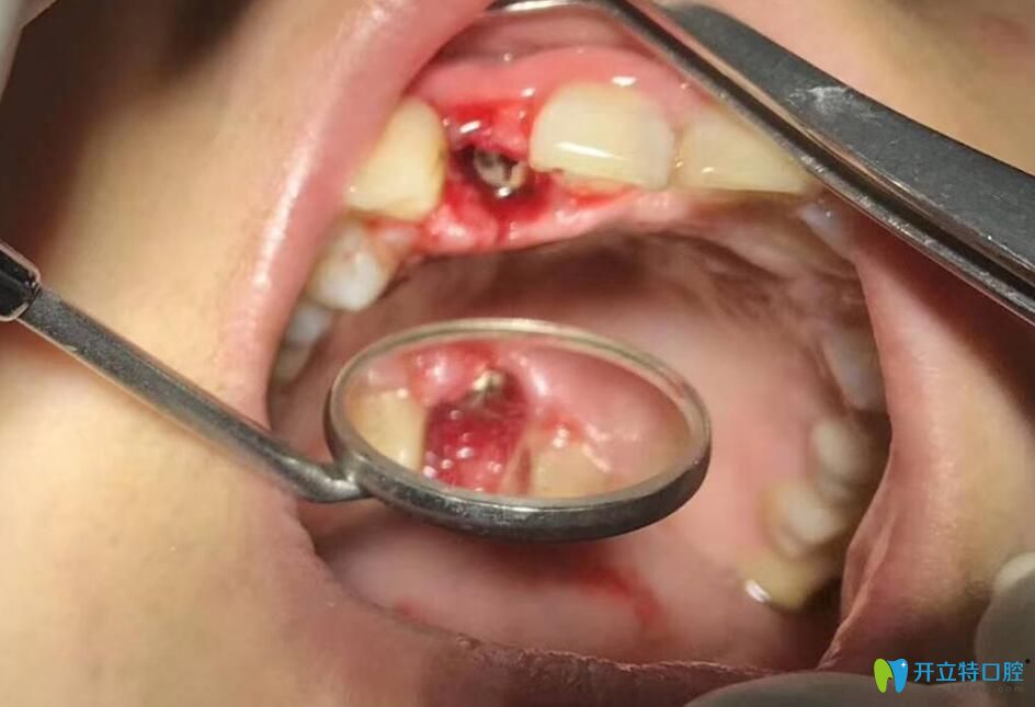 在深圳三康口腔拔牙后种植牙过程