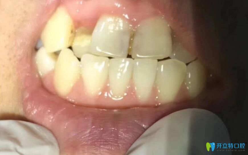 在深圳三康口腔种植前牙齿情况图