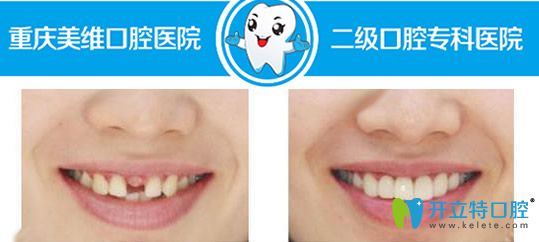 单颗牙缺失种植案例及前后对比效果