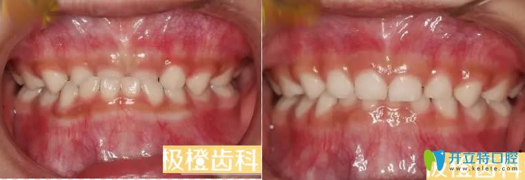 <!--<i data=20240703-sp></i>-->极橙齿科小孩地包天矫正案例及前后对比效果 <!--<i data=20240703-sp></i>-->极橙齿科小孩地包天矫正案例及前后对比效果