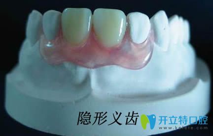 牙医解惑:隐形义齿能戴一辈子吗?隐形牙和烤瓷牙到底哪个好