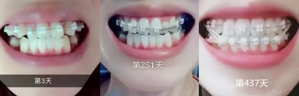 哈尔滨芽美口腔当牙齿影响颜值时，我去了哈尔滨芽美口腔做陶瓷托槽矫正