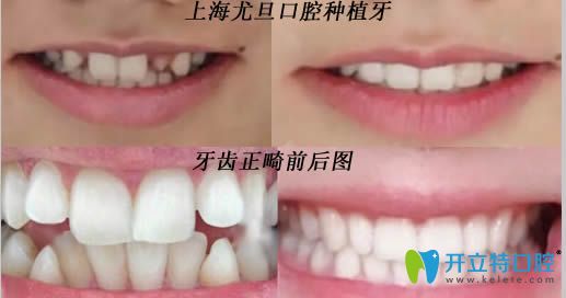 上海尤旦口腔种植牙和牙齿矫正案例效果图