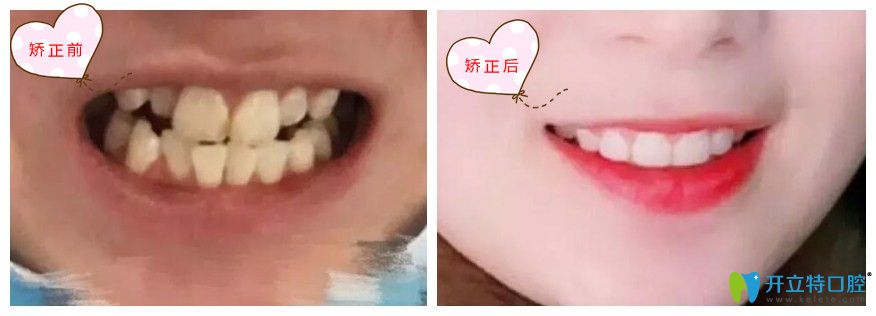 属于北京南区口腔牙齿矫正前后对比图