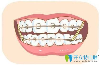 为什么牙齿矫正后容易长蛀牙?如何有效预防矫正中出现龋齿