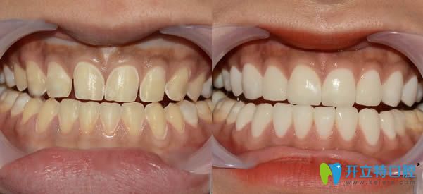 马婷医生牙齿瓷贴面案例效果对比图