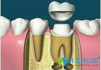 牙齿做过根管治疗后需要戴牙冠对其保护