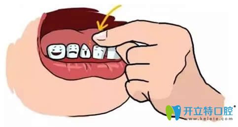 儿童牙齿意外脱落修复