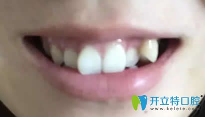 听说牙齿矫正后脸型会变,我在北京非凡口腔戴牙套1年才明白