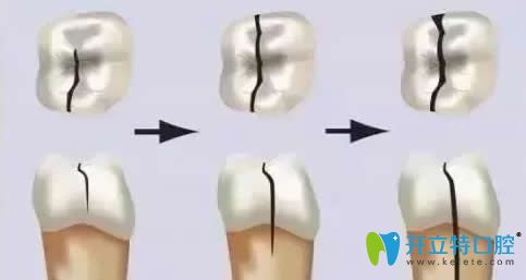 儿童牙齿的修复方法