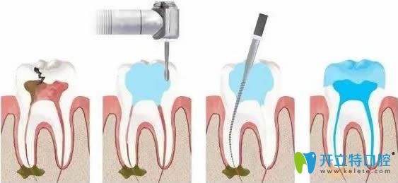 牙齿根管治疗步骤图解