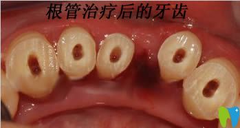 做过根管治疗后的牙齿图 做过根管治疗后的牙齿图