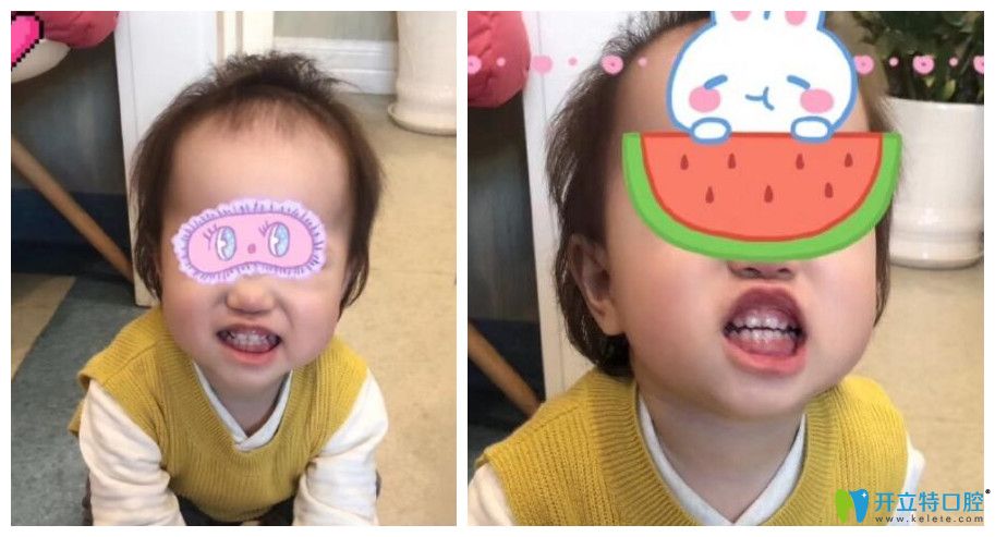 北京三叶儿童口腔收费价格表超详细，附儿童看牙实例反馈
