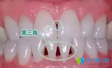 牙齿矫正后出现黑三角怎么办？介绍牙齿黑三角的治疗方法