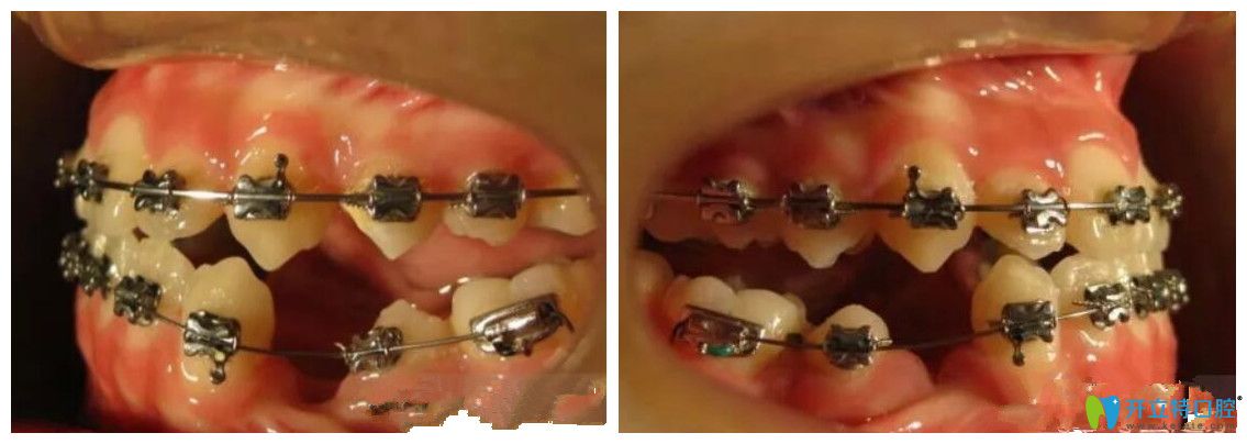 三叶儿童口腔上下牙套后牙齿照片