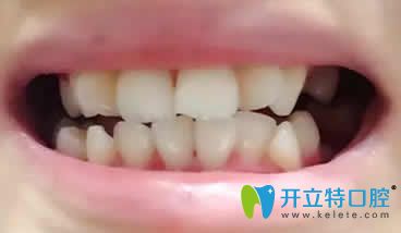 我在竹子口腔做隐形矫正第3个月照片 我在竹子口腔做隐形矫正第3个月照片