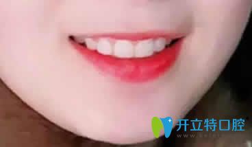 我在昆明竹子口腔做隐形矫正一年的效果 我在昆明竹子口腔做隐形矫正一年的效果