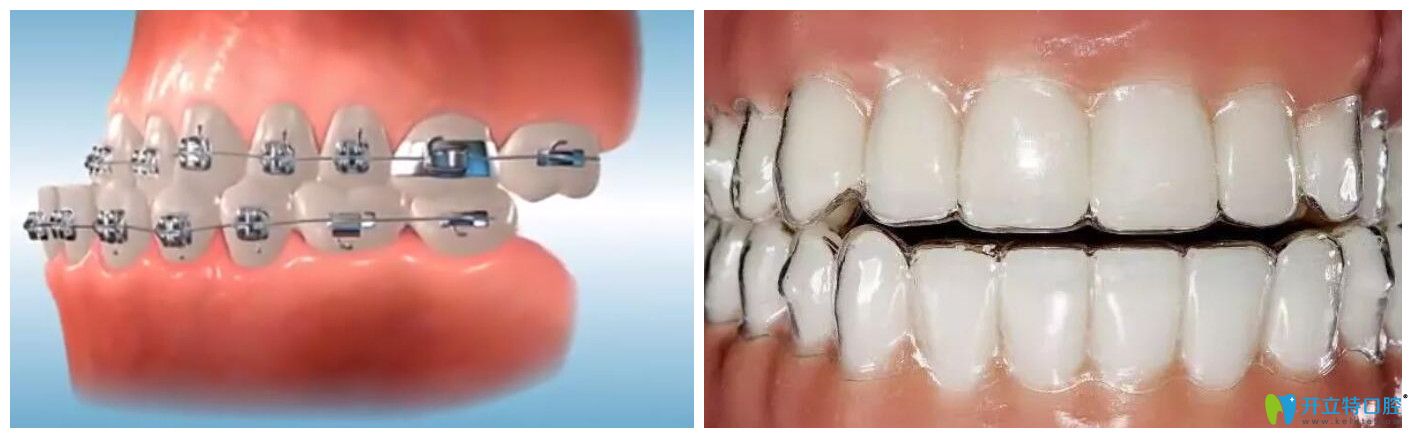 隐形牙套在正畸后期调整咬合的效果是不是不如传统牙套？