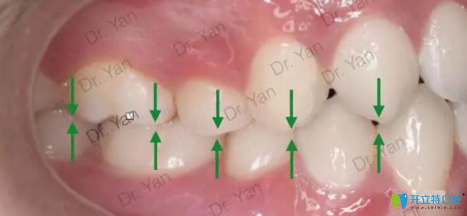 牙齿正畸中的咬合调整是什么