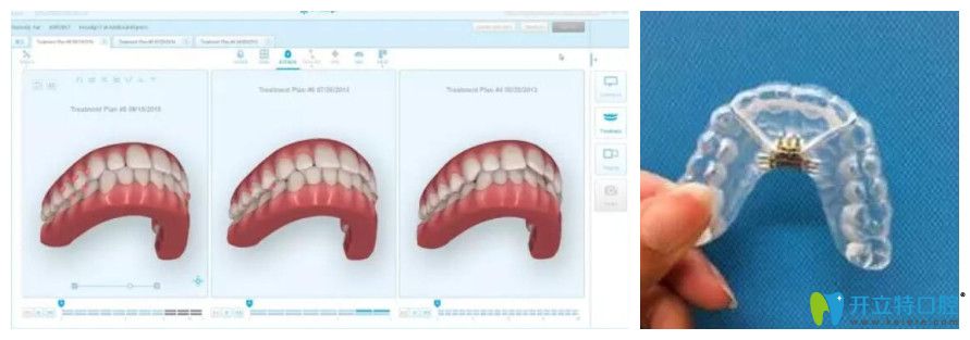  3D扫描后电脑上形成的3D模型及后期咬合微调阶段牙套模型