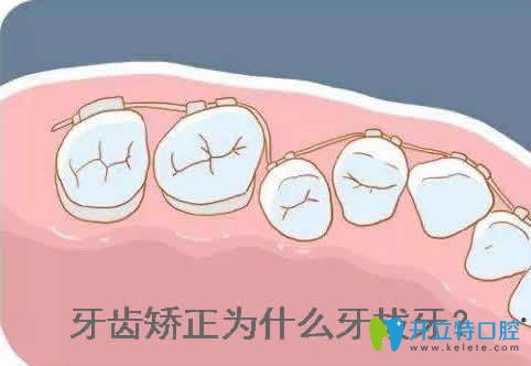 牙齿矫正为什么要拔牙