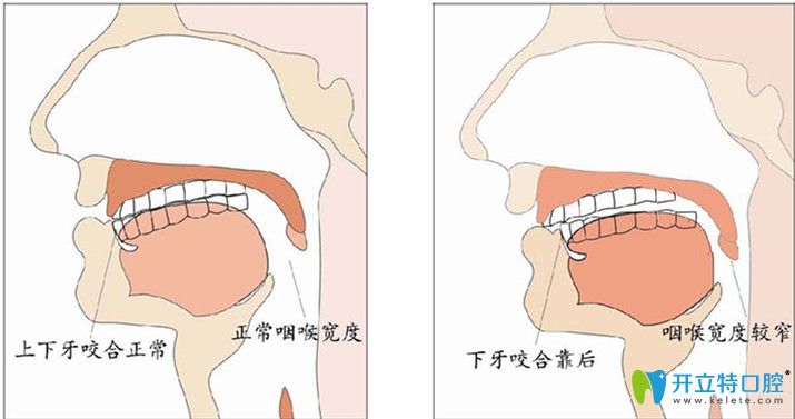 什么是咬合关系，你的咬合关系是否正常呢？