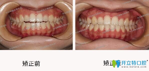 成都口腔哪里正畸好?圣贝口腔牙齿矫正效果来揭晓 成都口腔哪里正畸好?圣贝口腔牙齿矫正效果来揭晓