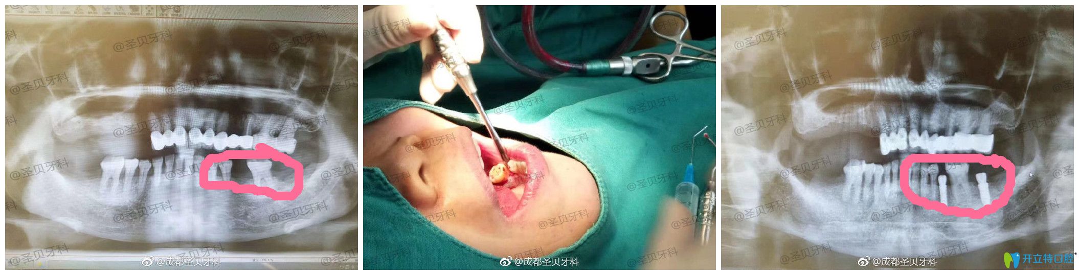 圣贝口腔种牙怎么样?案例效果来验证 圣贝口腔种牙怎么样?案例效果来验证