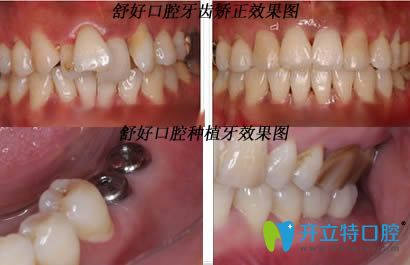 威海舒好口腔种植牙和牙齿正畸案例效果图
