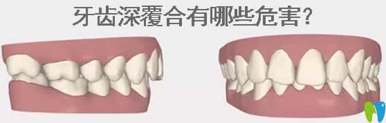 牙齿深覆合有哪些危害