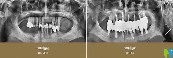 全口牙缺失种植案例及CT前后对比效果