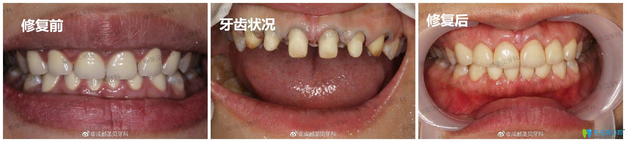 圣贝口腔牙齿修复案例 圣贝口腔牙齿修复案例