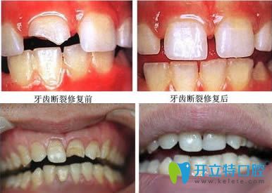 上海恒愿齿科常红琴牙体修复案例效果对比图