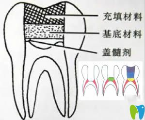 牙齿盖髓术图解