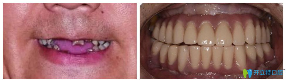 太原众牙口腔全口种牙案例前后效果对比