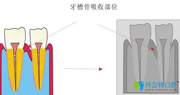 牙槽骨缺失图