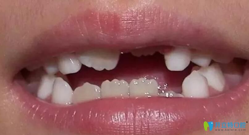 为什么小孩换的新牙是“锯齿”，这正常吗？该怎么办？